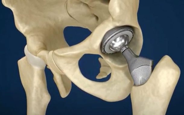 On the ball with hip implants